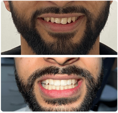 results from invisalign offers near me in Dewsbury